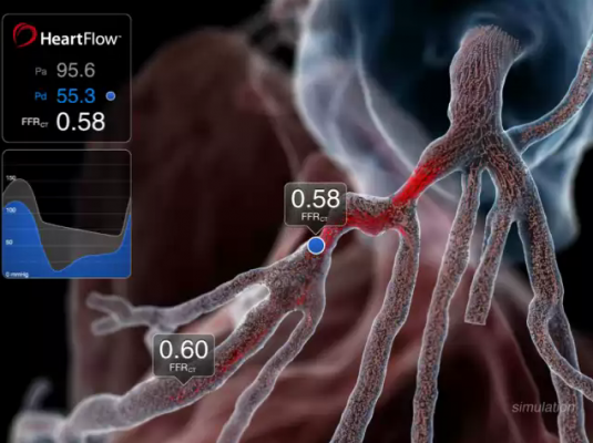 Noninvasive FFR-CT Identifies Flow-Restricting Coronary Artery